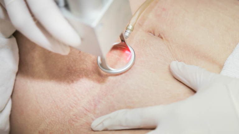 Bệnh viện Đa khoa Quốc Tế Thu Cúc là một trong những địa chỉ uy tín trong việc điều trị rạn da bằng tia laser.