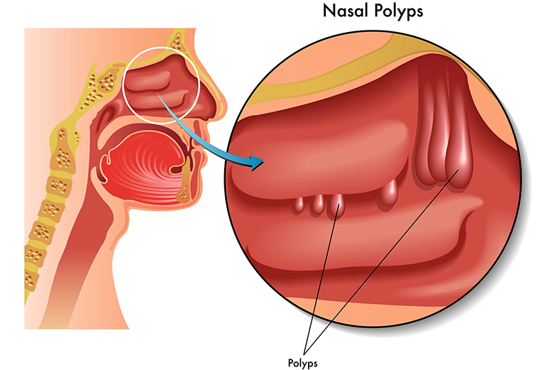 Vì sao cần phải phẫu thuật cắt polyp mũi?