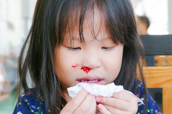 Trẻ bị chảy máu cam thường xuyên là dấu hiệu của bệnh gì?