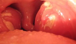 Tìm hiểu về bệnh viêm amidan đáy lưỡi và cách điều trị