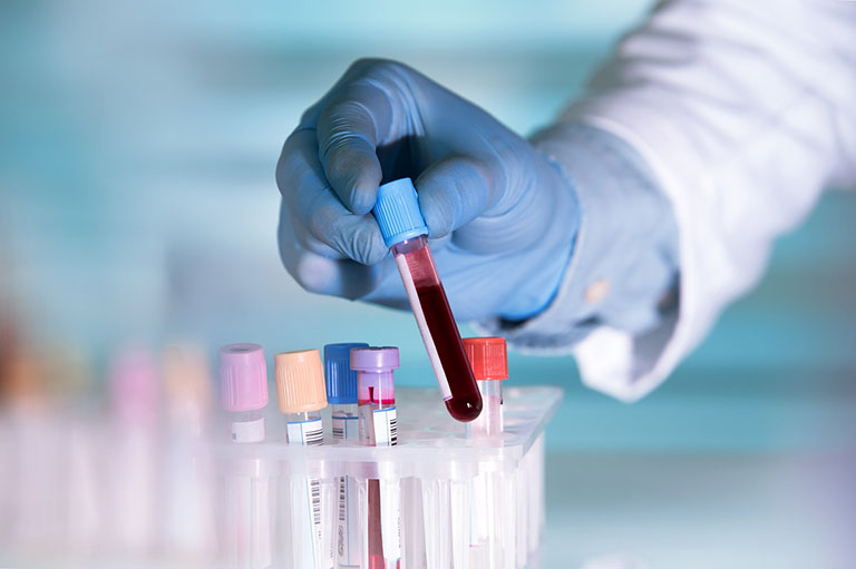 Xét nghiệm máu được chỉ định để kiểm tra xem có tồn tại vi khuẩn Hp hay không 