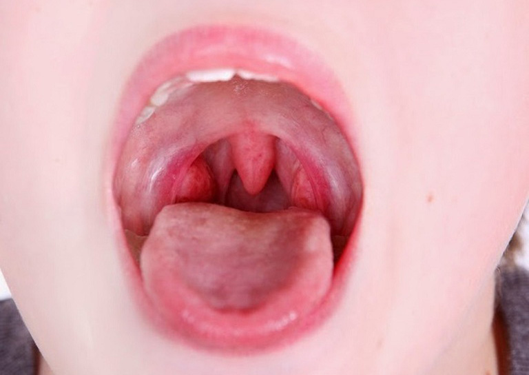trẻ em bị viêm mũi dị ứng