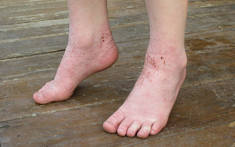 triệu chứng viêm da cơ địa ở chân