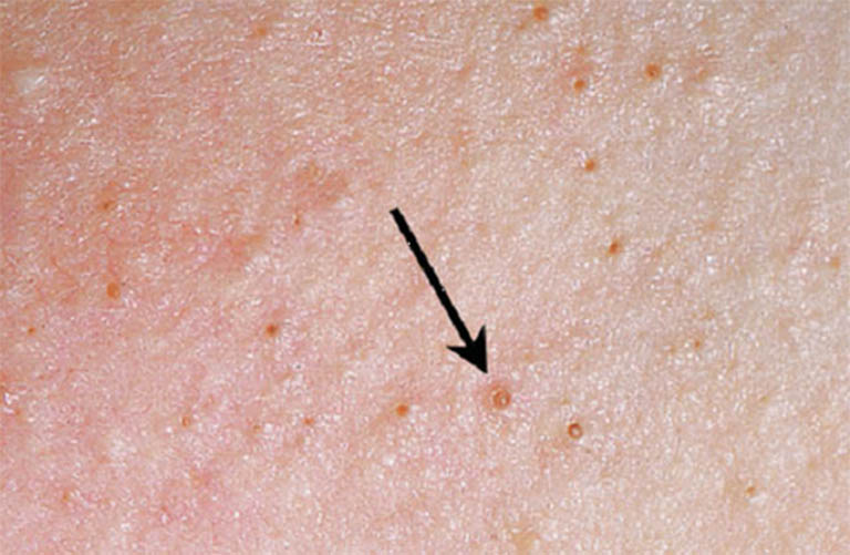 Dấu hiệu nhận biết bệnh viêm nang lông ở ngực
