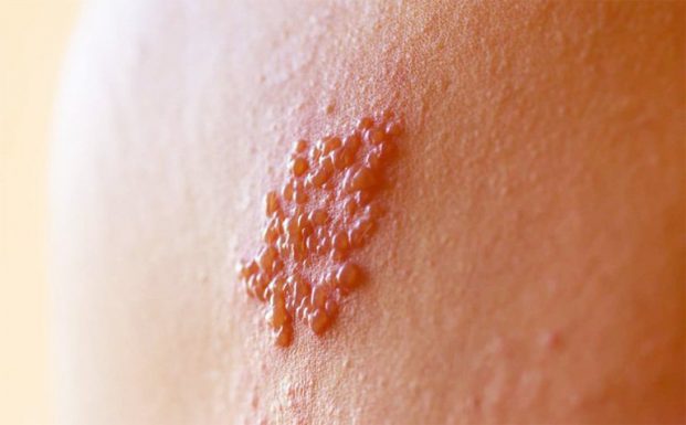 Bệnh giời leo có lây không, làm sao để phòng ngừa?