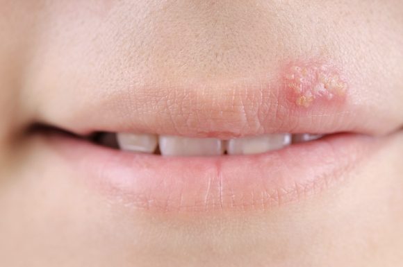 bị zona thần kinh ở môi