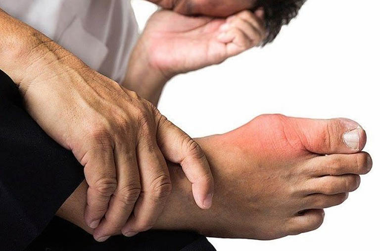 dấu hiệu nhận biết bệnh gút ở tay và chân