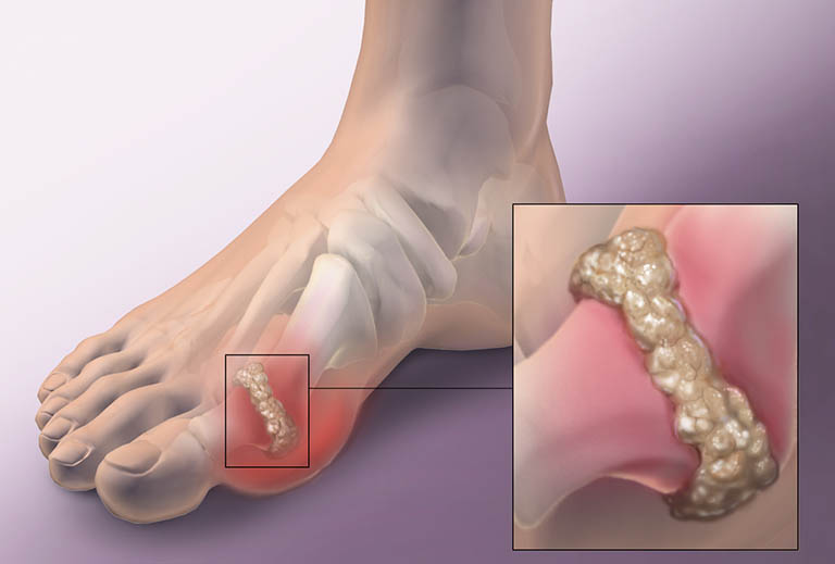 Nguyên tắc điều trị bệnh gout