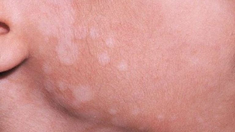 Lang ben thường làm cho vùng da bị bệnh giảm hoặc mất sắc tố 