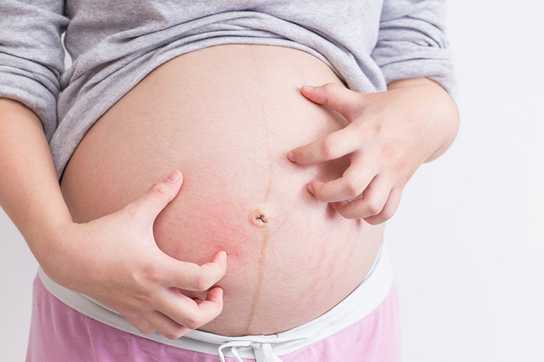 triệu chứng viêm da cơ địa khi mang thai
