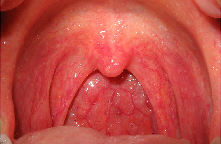 Bệnh viêm họng