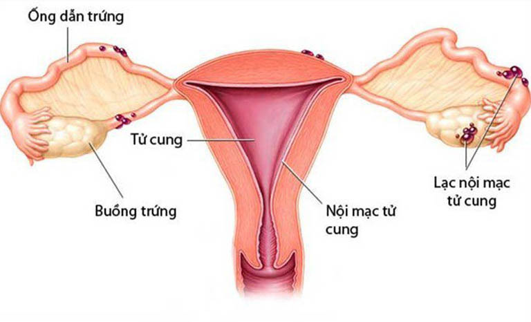 Bệnh viêm nội mạc tử cung
