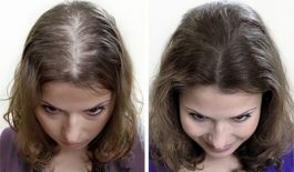 7 cách trị hói đầu ở nữ - Giúp tóc mọc dài, dày nhanh