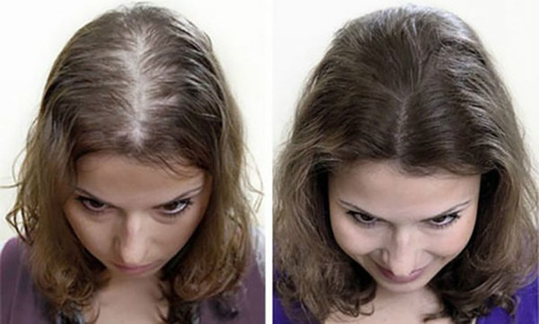 Hạn chế nguy cơ rụng tóc hói đầu như thế nào  Rungtocvn