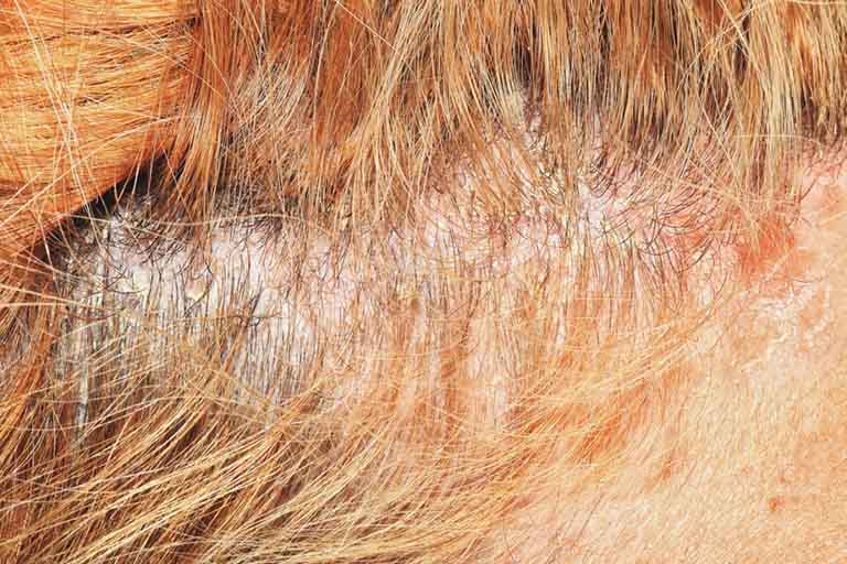 Đầu nhiều gàu có thể là dấu hiệu cảnh báo một số bệnh lý về da đầu