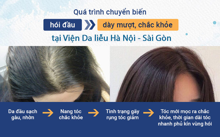 Giải pháp ngăn rụng tóc và kích thích mọc tóc của Viện Da liễu Hà Nội - Sài Gòn đem lại hiệu quả phục hồi nhanh chóng