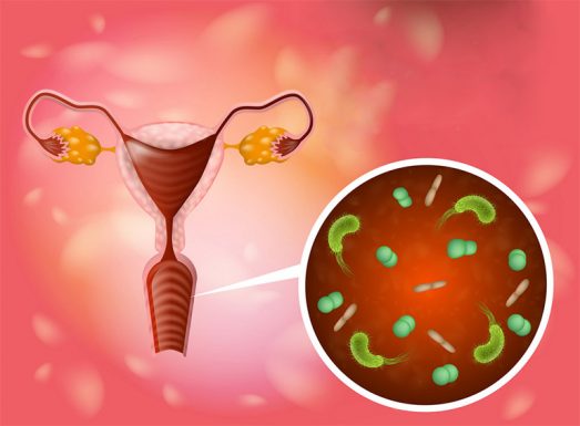 Viêm phụ khoa nhiễm nấm, tạp khuẩn