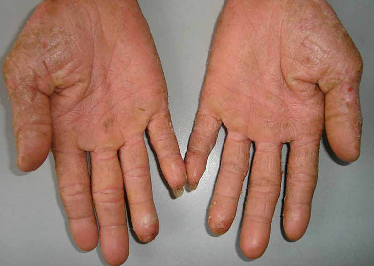 Dấu hiệu bệnh á sừng ở tay, đầu ngón tay và cách trị