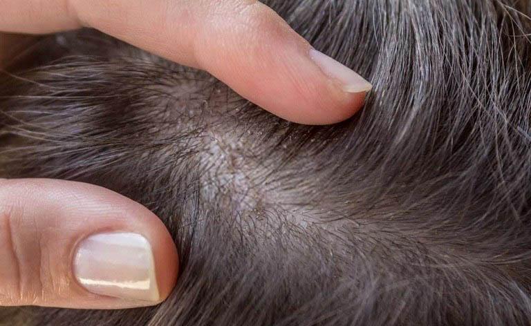 Tóc rụng có hạt trắng ở chân tóc khắc phục bằng cách nào?