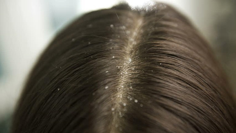 Chân tóc có nhân mụn là bị làm sao Có cách nào trị hiệu quả không