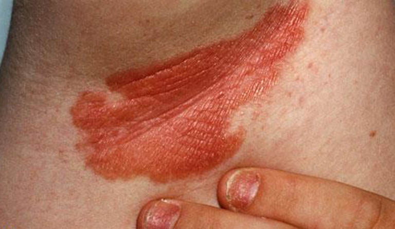 Vảy nến ở nách là một tổn thương ngoài da và là một đặc trưng cơ bản của bệnh vảy nến đảo ngược