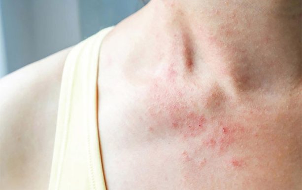 Viêm da tiếp xúc và zona: Cách phân biệt, nhận biết