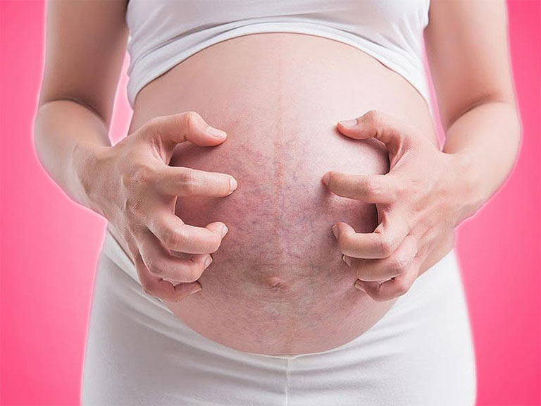 Sự thay đổi cấu trúc da vùng bụng trong suốt quá trình mang thai cũng chính là nguyên nhân gây nên cơn ngứa ngáy khó chịu