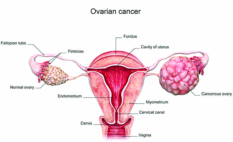 Tỉ lệ mang thai thành công của những người phụ nữ đã cắt một bên buồng trứng do ung thư là 30%.