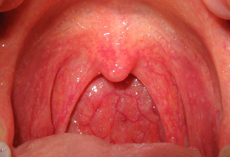 Bệnh viêm họng cấp tính