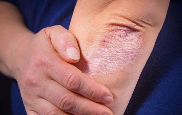Cách chăm sóc bệnh nhân vảy nến nhanh phục hồi