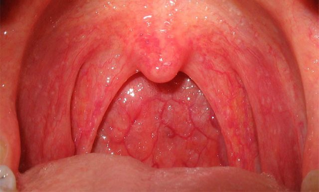 Đau vòm họng do viêm họng bình thường hay ung thư?