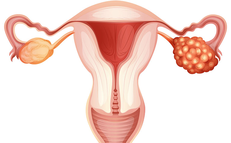 Các giai đoạn ung thư buồng trứng - Điều cần biết