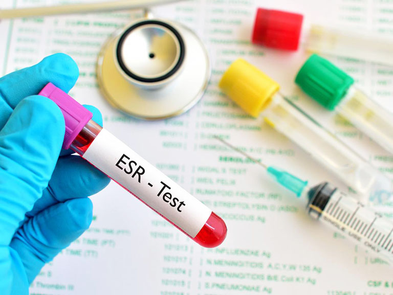 Xét nghiệm tỷ lệ hồng cầu lắng (ESR) là thủ thuật xét nghiệm máu để biết chính xác độ viêm nhiễm trong cơ thể của người phụ nữ