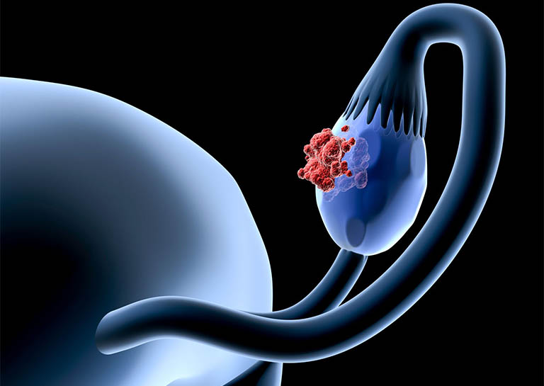 Những giai đoạn phát triển của bệnh ung thư buồng trứng