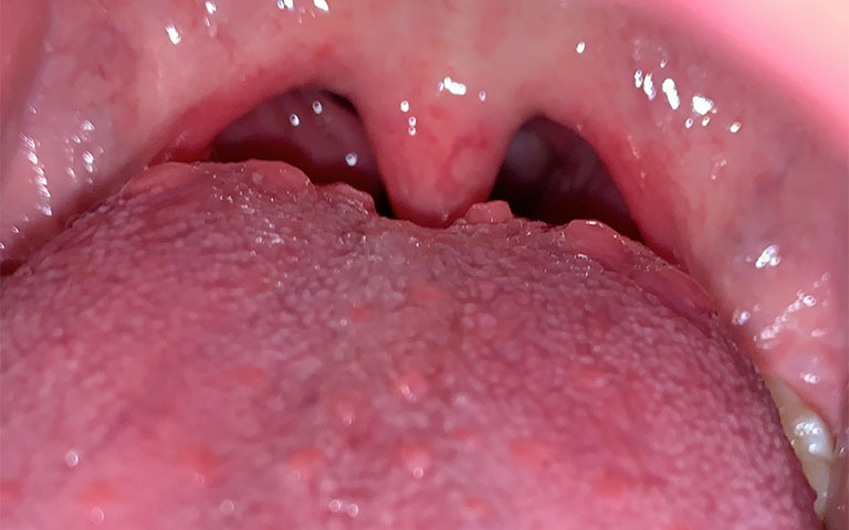 Viêm họng hạt ở lưỡi hình thành do đâu?