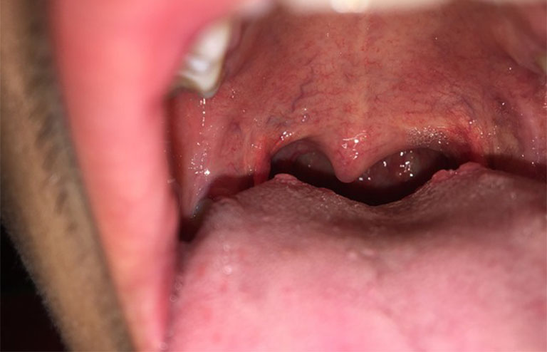 Các biểu hiện của viêm họng hạt ở lưỡi