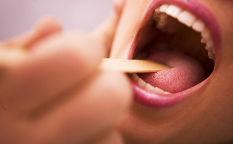 Viêm họng hạt ở lưỡi là gì?