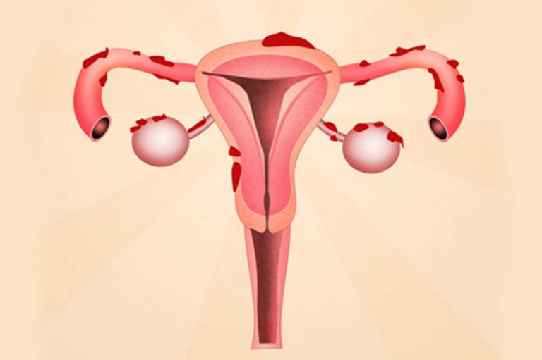 Lạc nội mạc tử cung khi mang thai có ảnh hưởng gì?