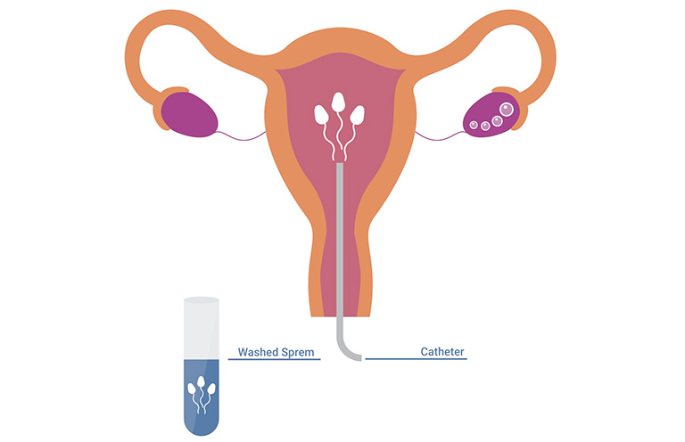 IUI là phương pháp hỗ trợ sinh sản thông qua kỹ thuật bơm tinh trùng của nam vào trong tử cung của phụ nữ