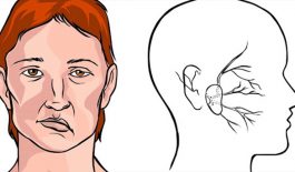 Vật lý trị liệu liệt cơ mặt (dây thần kinh số 7)