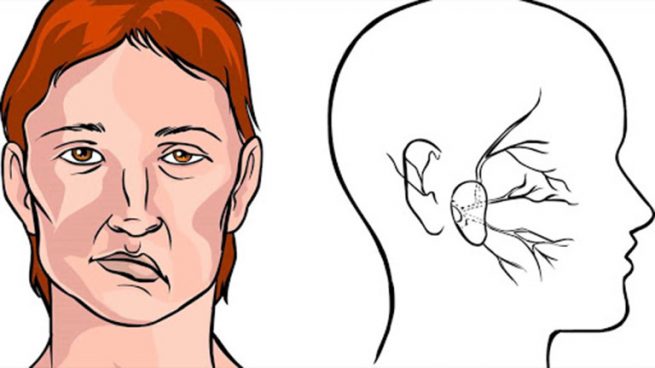 Vật lý trị liệu liệt cơ mặt (dây thần kinh số 7)