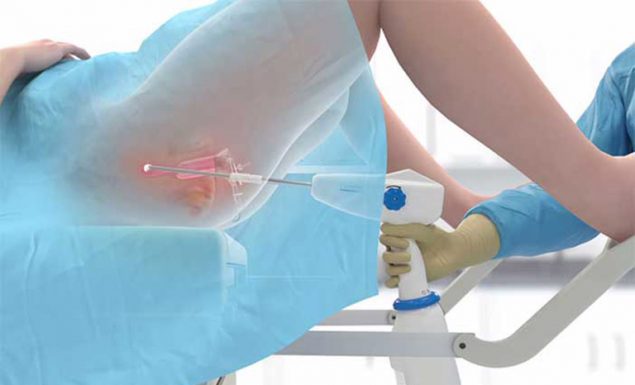 Áp lạnh cổ tử cung ảnh hưởng gì không? Điều cần biết