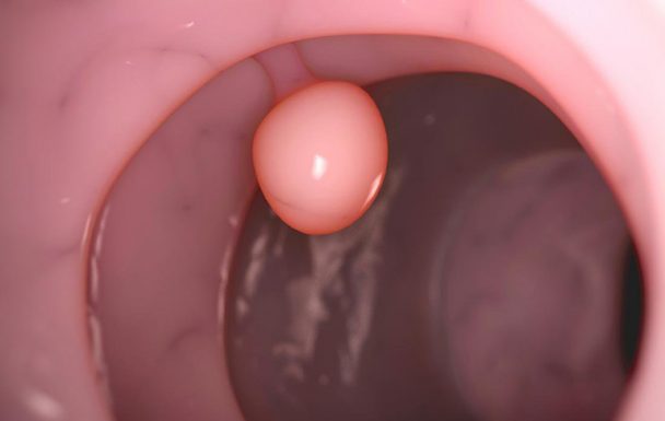 Polyp hang vị dạ dày là gì? Thông tin cần biết