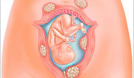 U xơ tử cung khi mang thai là gì?
