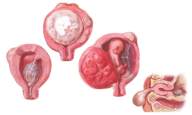 Tính chất của khối u xơ tử cung tác động khá lớn đến khả năng thụ thai của chị em phụ nữ mắc bệnh