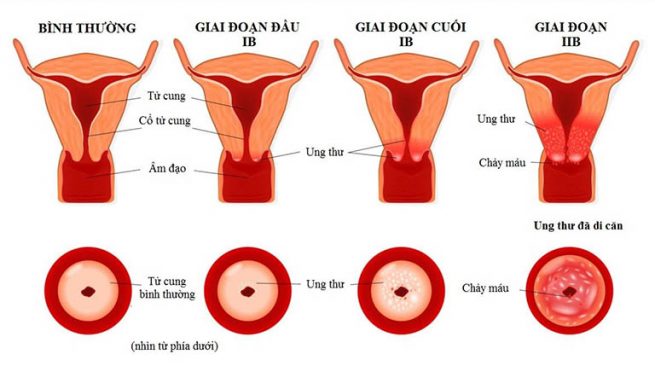 Các giai đoạn ung thư cổ tử cung