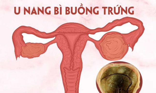 U nang bì buồng trứng là gì? Nguy hiểm không?