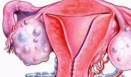 Biểu hiện của u nang buồng trứng ác tính và cách điều trị