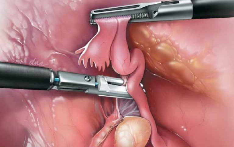 Những trường hợp u nang buồng trứng gây vô sinh