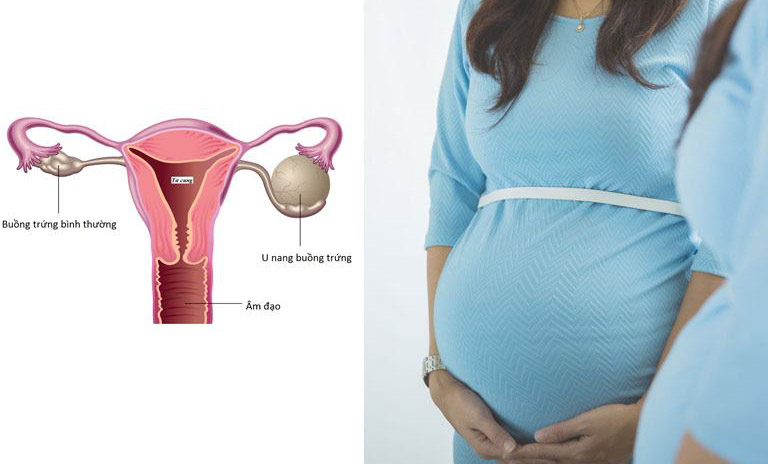 Dấu hiệu nhận biết u nang buồng trứng khi mang thai